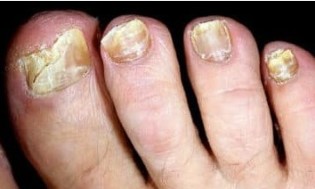 Pericol de onychomycosis